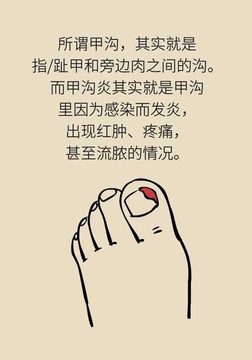 甲沟炎痛的无法剪指甲怎么办,甲沟炎清理过了为什么还是痛