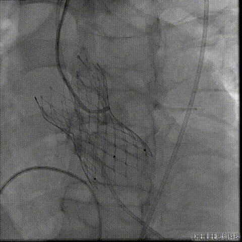 病例回顾与分享,腹膜后血肿介入治疗