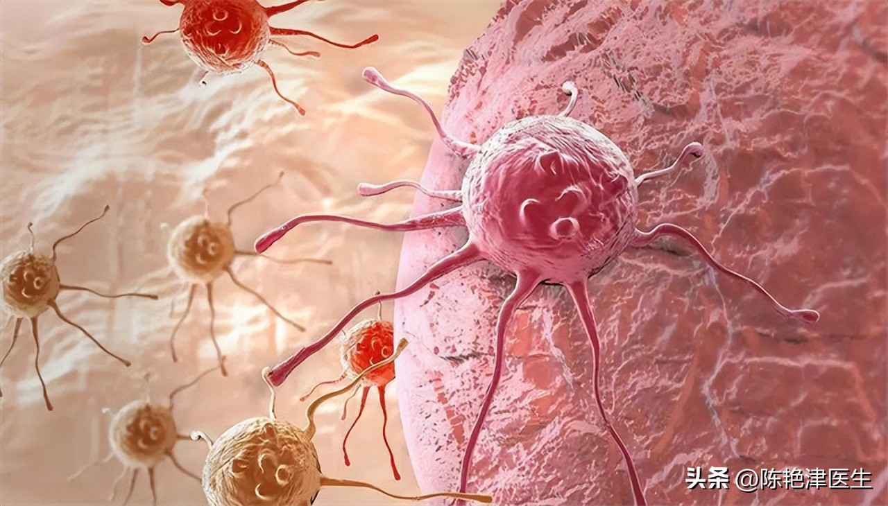 卵巢癌一发现就是晚期吗,卵巢癌一般发现就是晚期吗