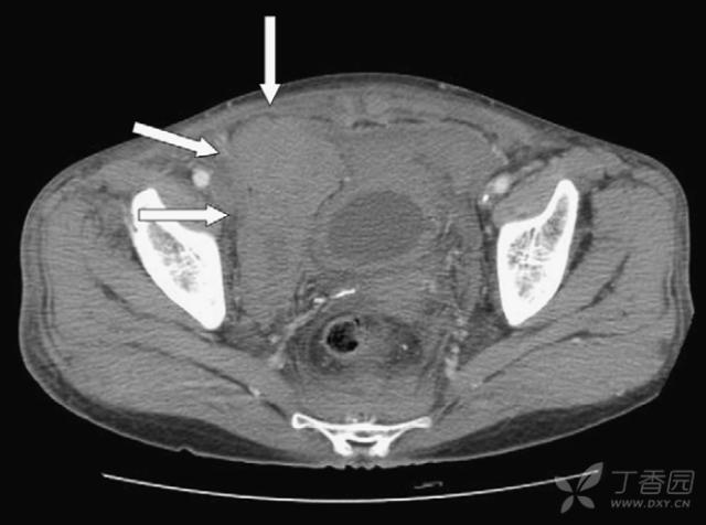 女性腹部突发疼痛怎么回事,女性65岁突然下腹疼有出血怎么了