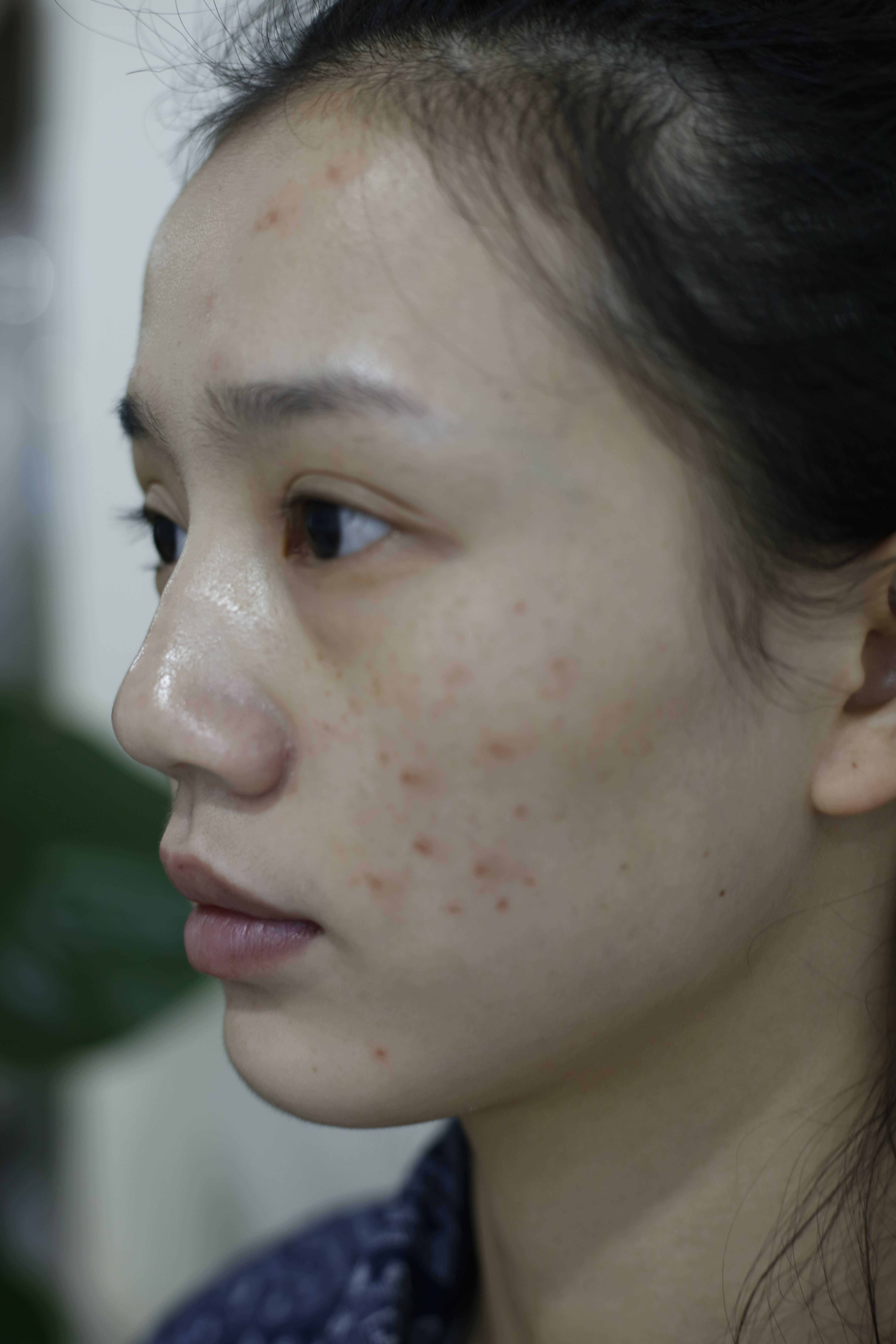 再漂亮的小姐姐也会被痘印困扰，治疗完后感叹激光治疗效果真不错