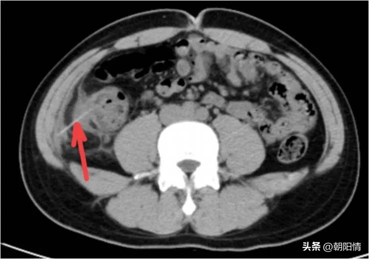 消化道异物中医诊断名称,消化道骨性异物