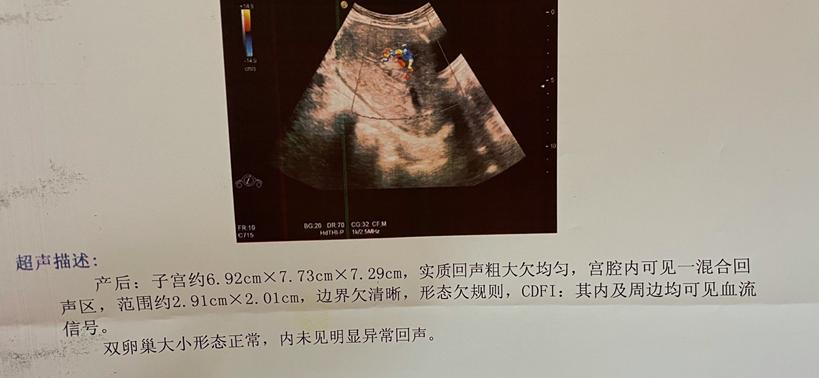 产后13天流好多血块,产后30天还流鲜血正常不