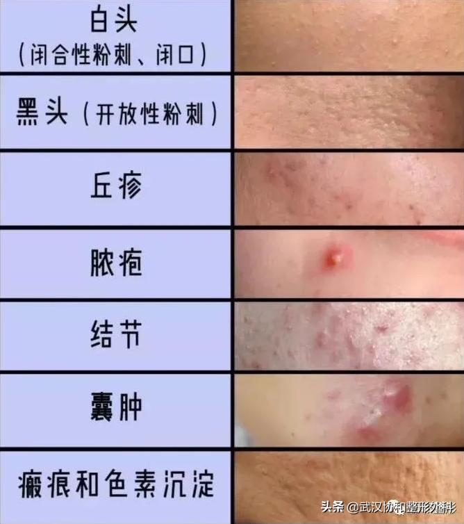 下巴反反复复有痘痘,脸上起痘痘反反复复