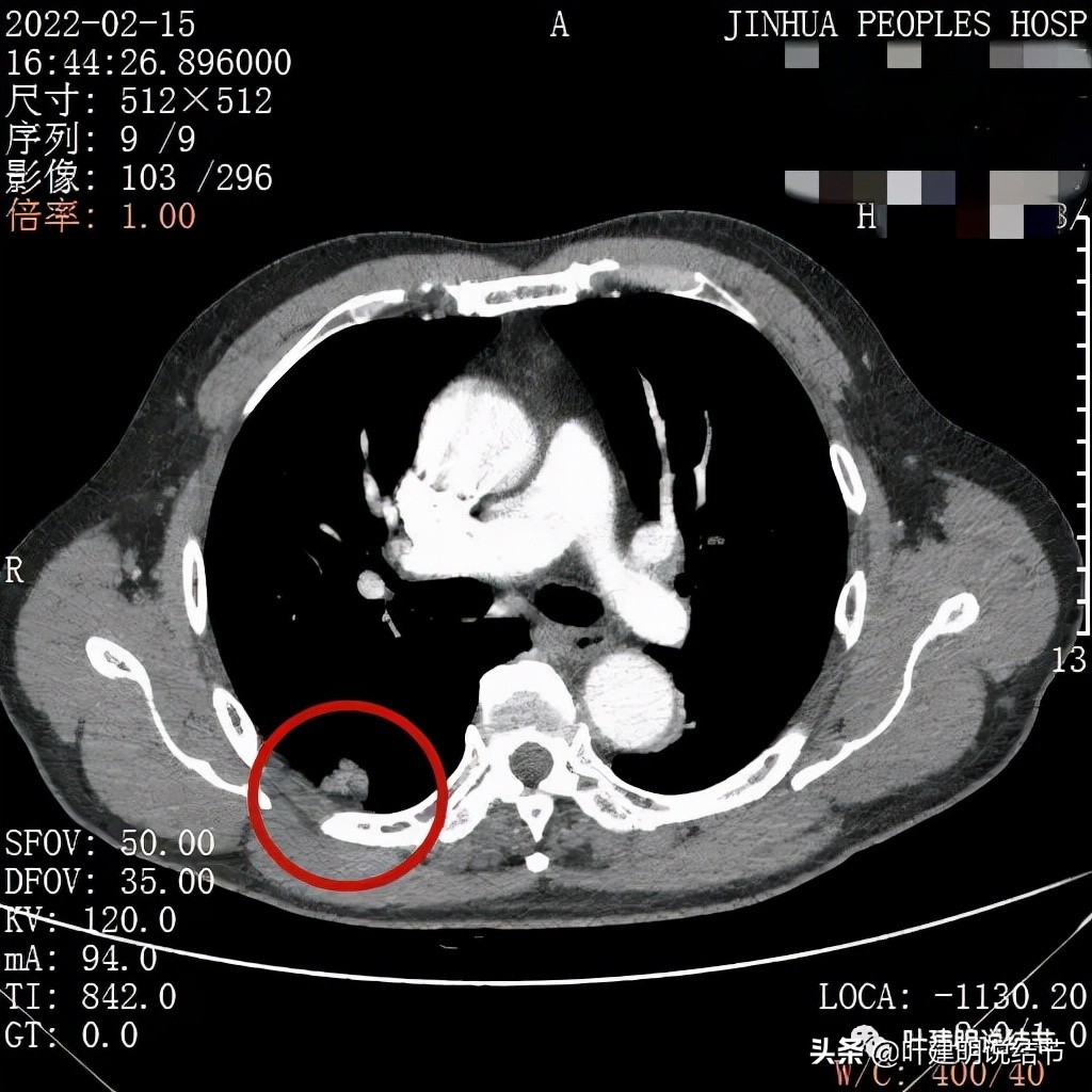肺腺癌高危亚型什么意思,肺腺癌高危亚型