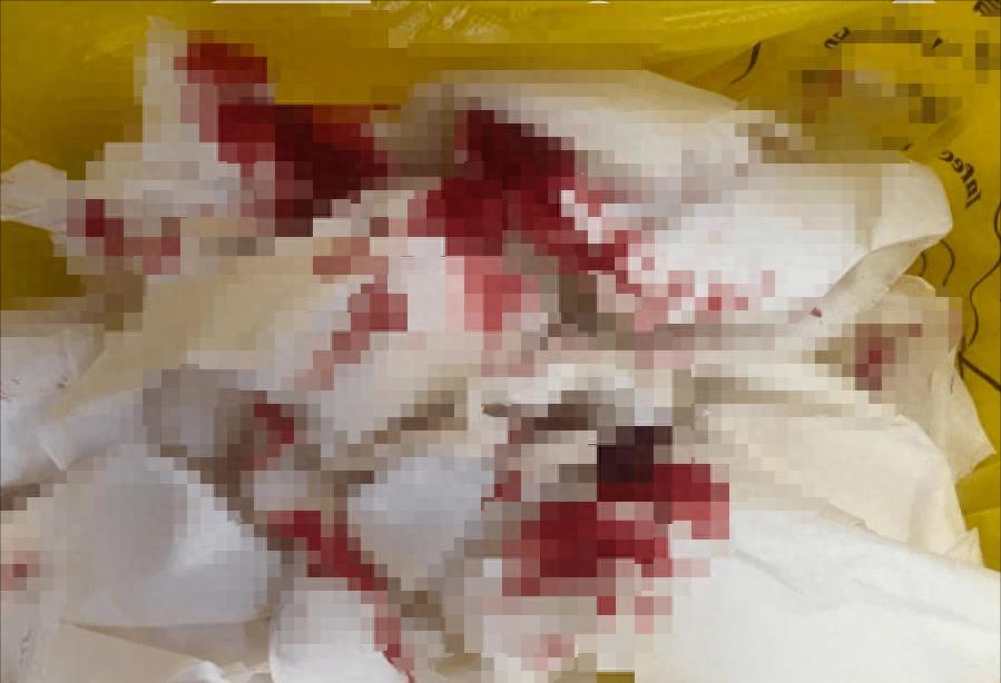 临终老人被强行抢救,癌症晚期昏迷插胃管