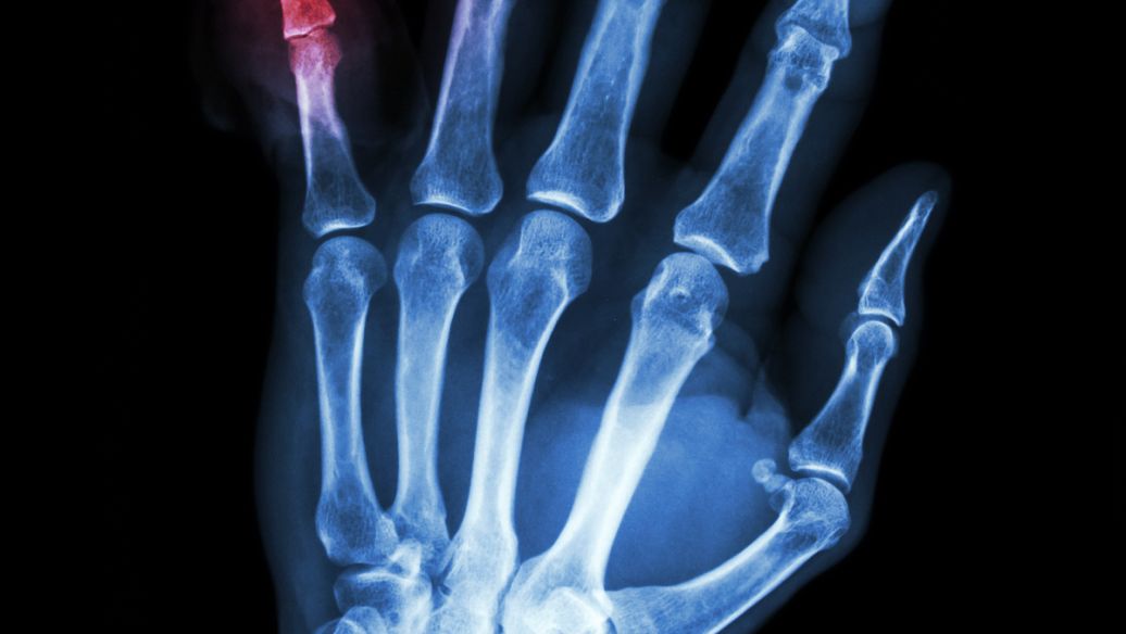 王宝强痛风吃什么药,王宝强痛风发作是什么节目