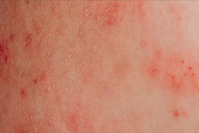 化疗引起周围神经病变,化疗导致周围神经病变