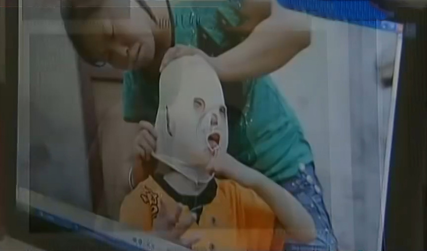 男孩因为烧伤惨遭毁容,被烧伤毁容的男孩