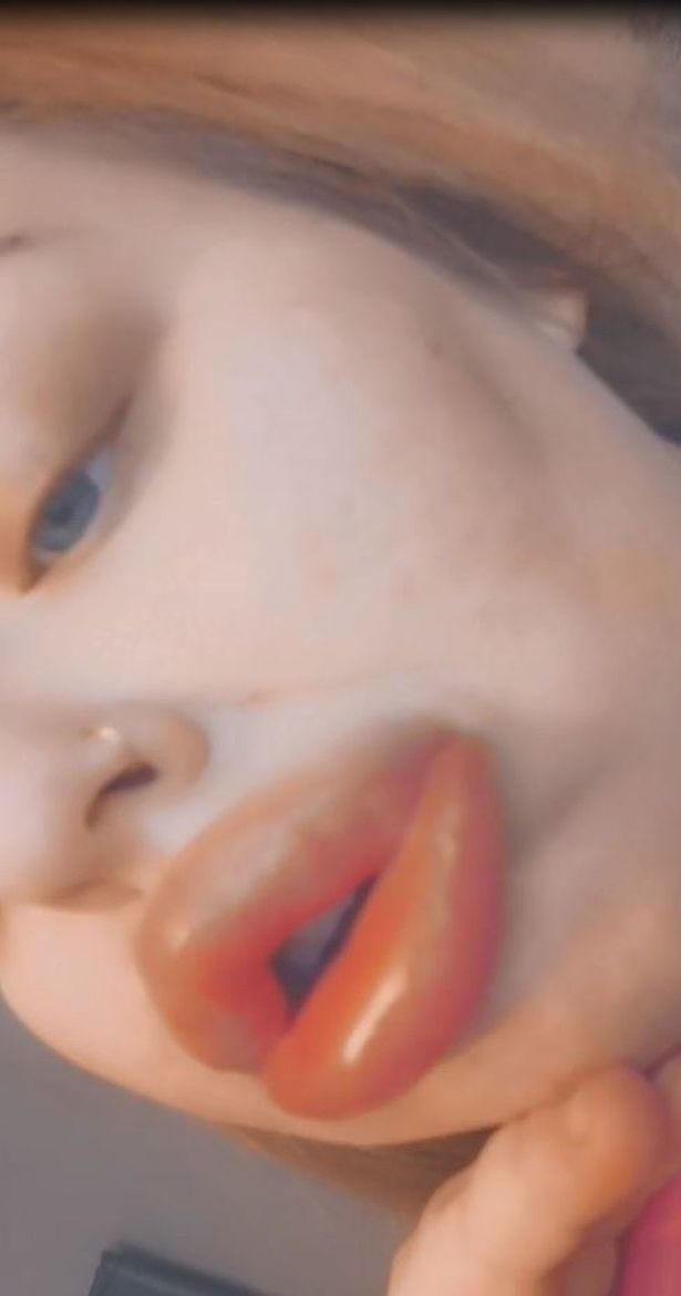 英国女子整容后做8次手术保命,丰唇手术后变成香肠嘴