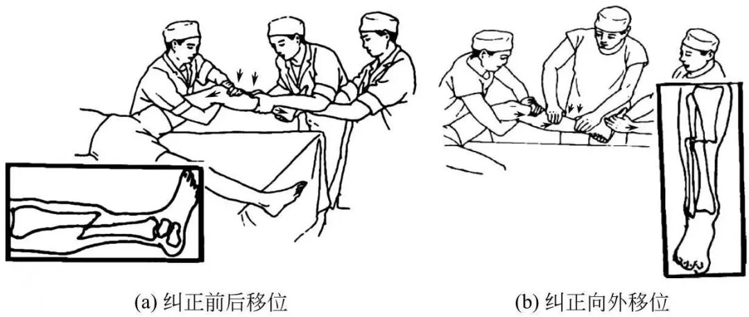 胫腓骨术后骨折愈合的征兆,胫腓骨骨折手术后多久踩地