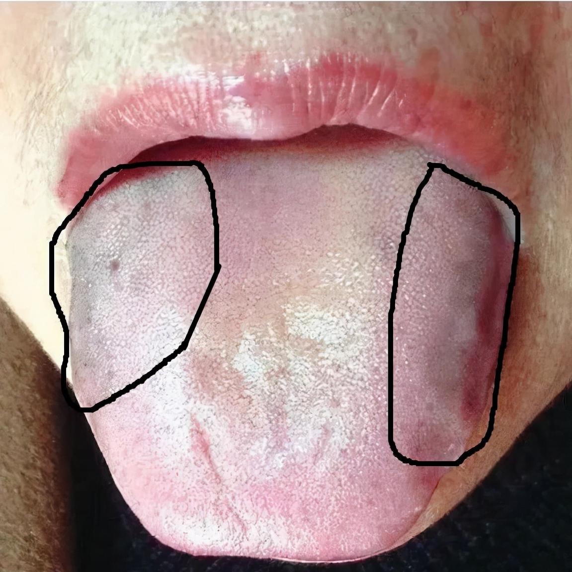 中医四诊中的正常舌象,中医看舌象准还是摸脉准