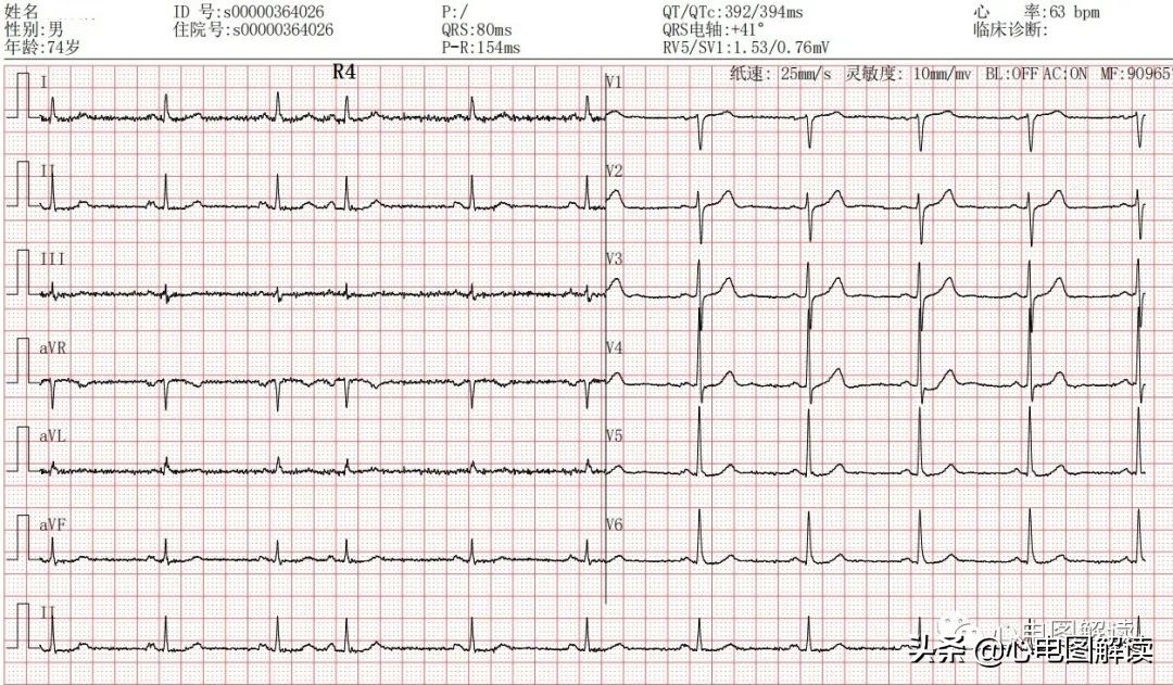 房性早搏二联律的解释,房性早搏二联律正常吗