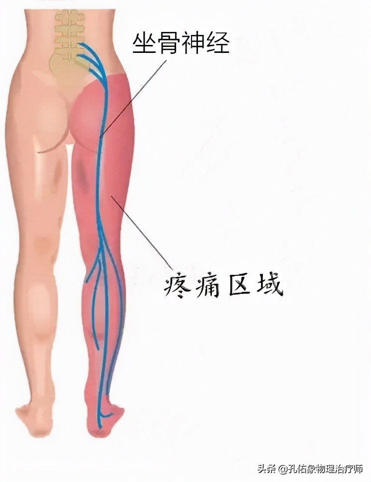 导致坐骨神经痛的原因是什么,坐骨神经痛有些反复什么原因