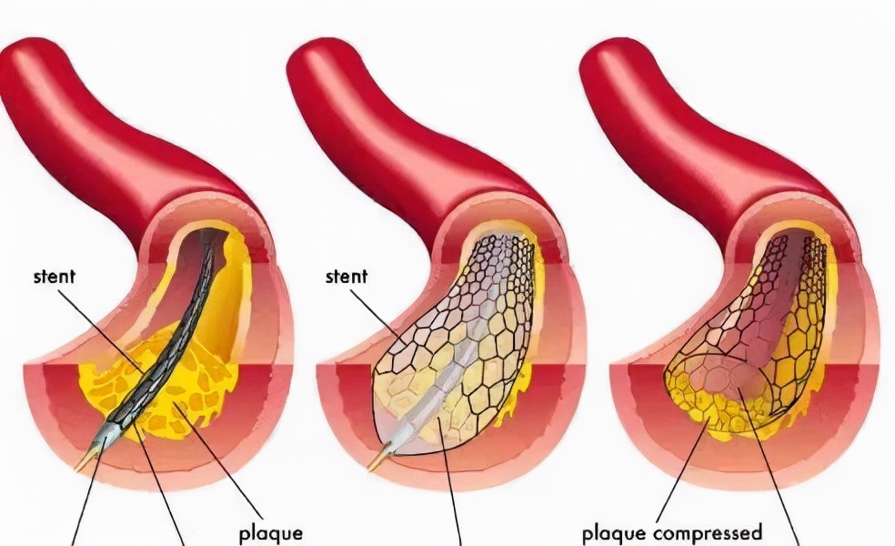 心脏支架手术可怕的吗 (心脏支架的严重后果)