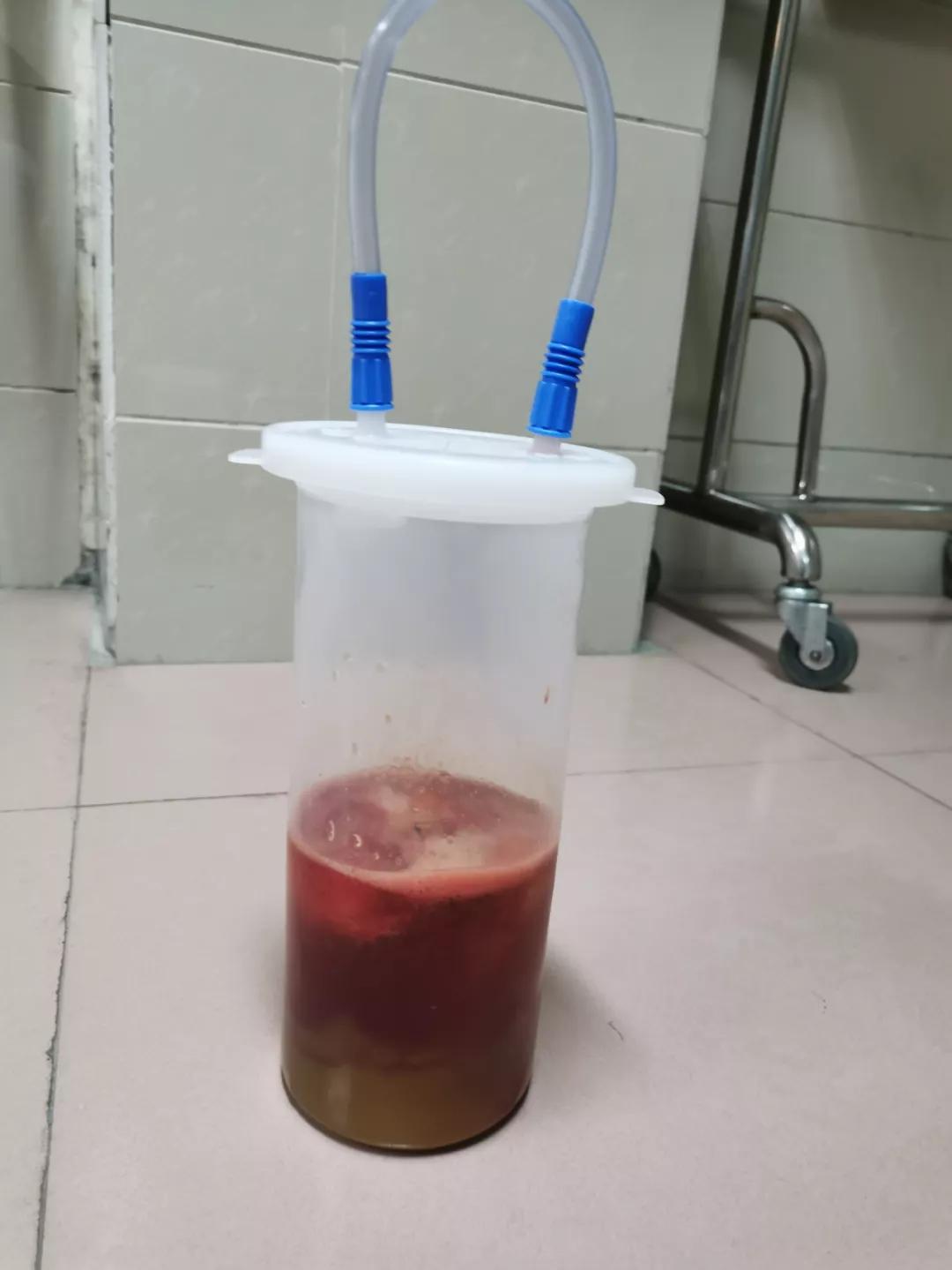 卵巢囊肿微创手术后患者状况,腹腔镜下卵巢囊肿切除术步骤