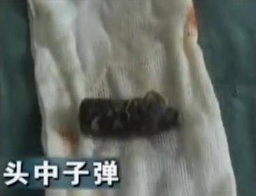 故事:江苏70岁老人头疼欲裂,检查时发现颅内有*弹子**,吓坏在场医生