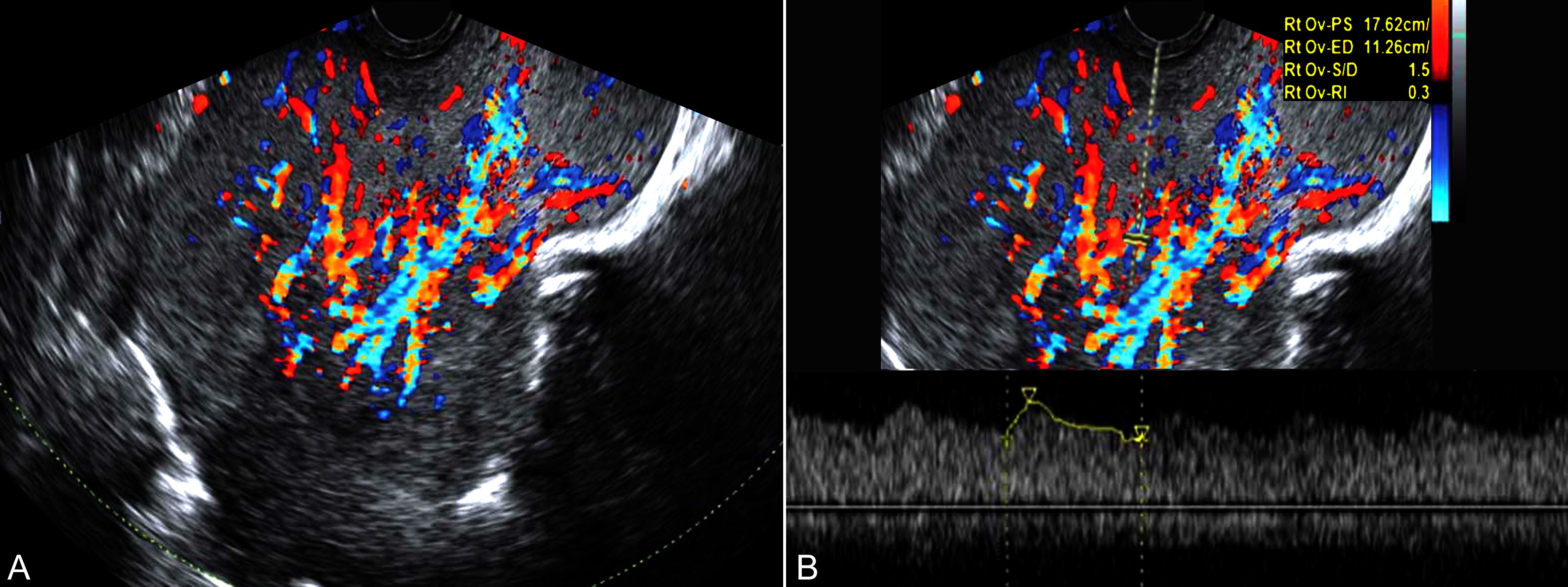 妊娠合并卵巢肿瘤指南,妊娠合并卵巢肿瘤严重吗