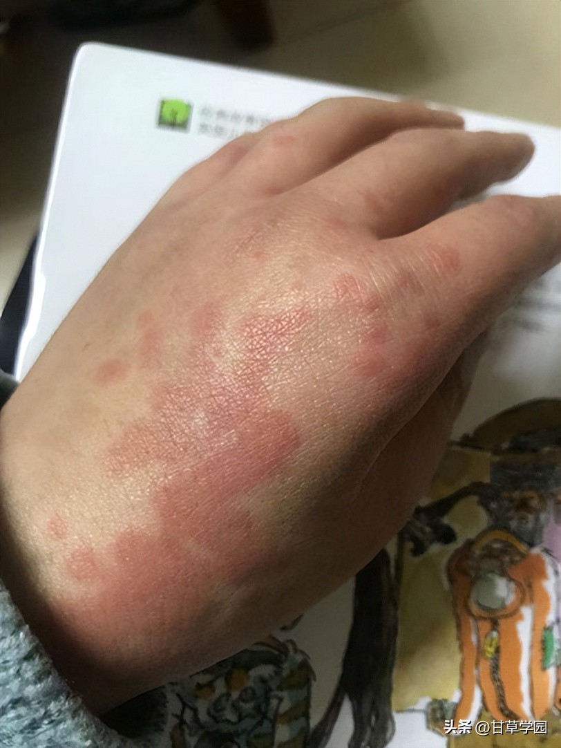 薯蓣丸治疗荨麻疹,柴胡桂枝干姜汤治疗荨麻疹