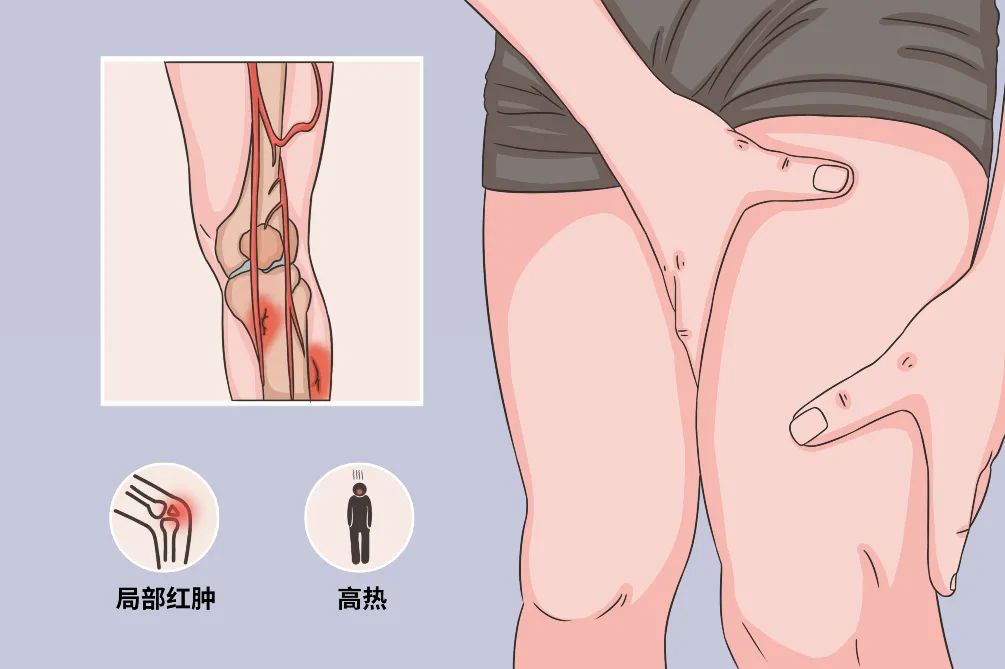 骨折内固定会导致内翻受限吗,骨折外固定容易感染吗