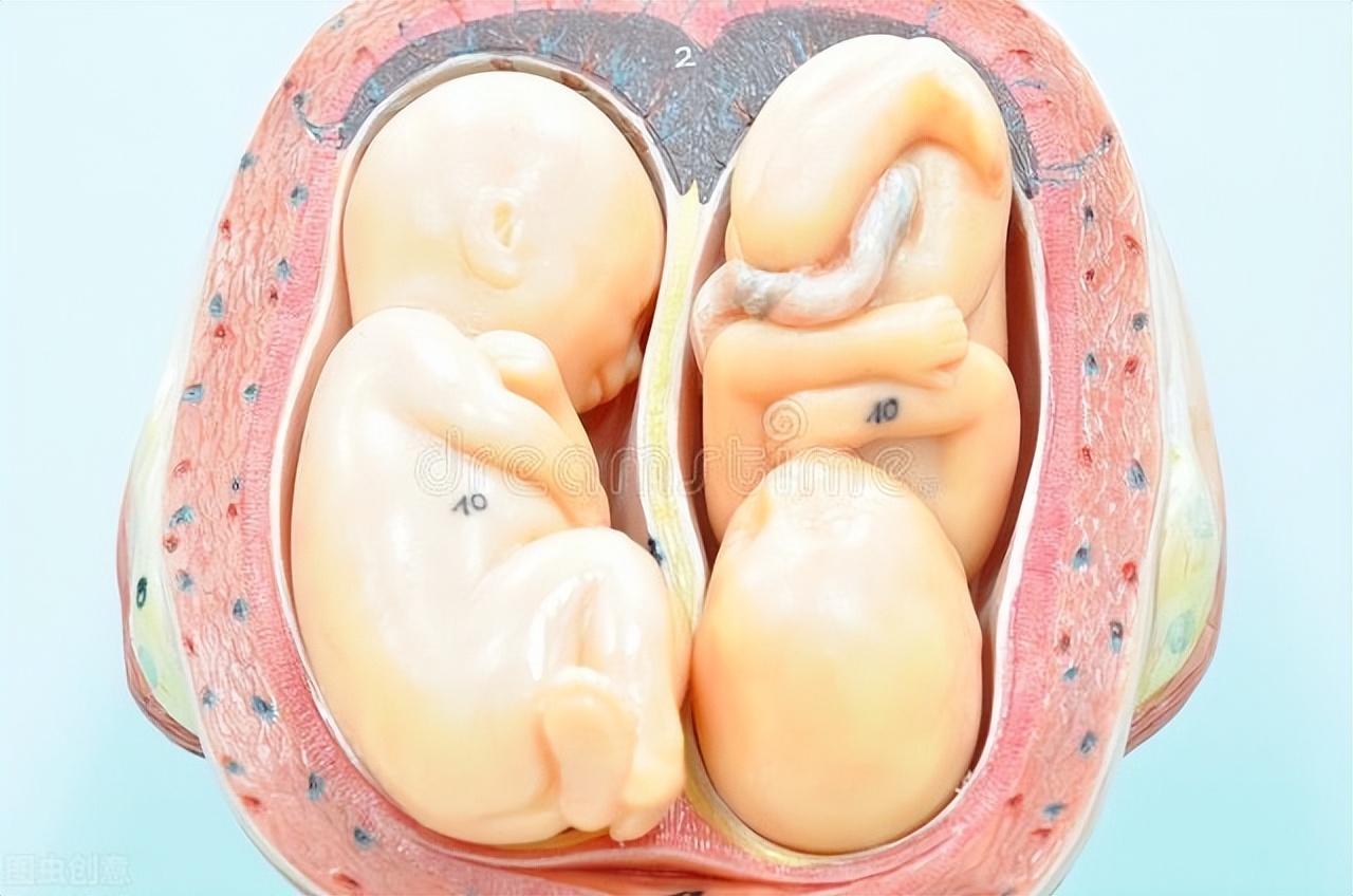 两个子宫会易怀双胞胎吗,两个子宫有双胞胎吗