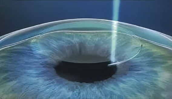 史上超全近视手术全攻略摘镜必看,近视手术怎么做收好这份免费攻略