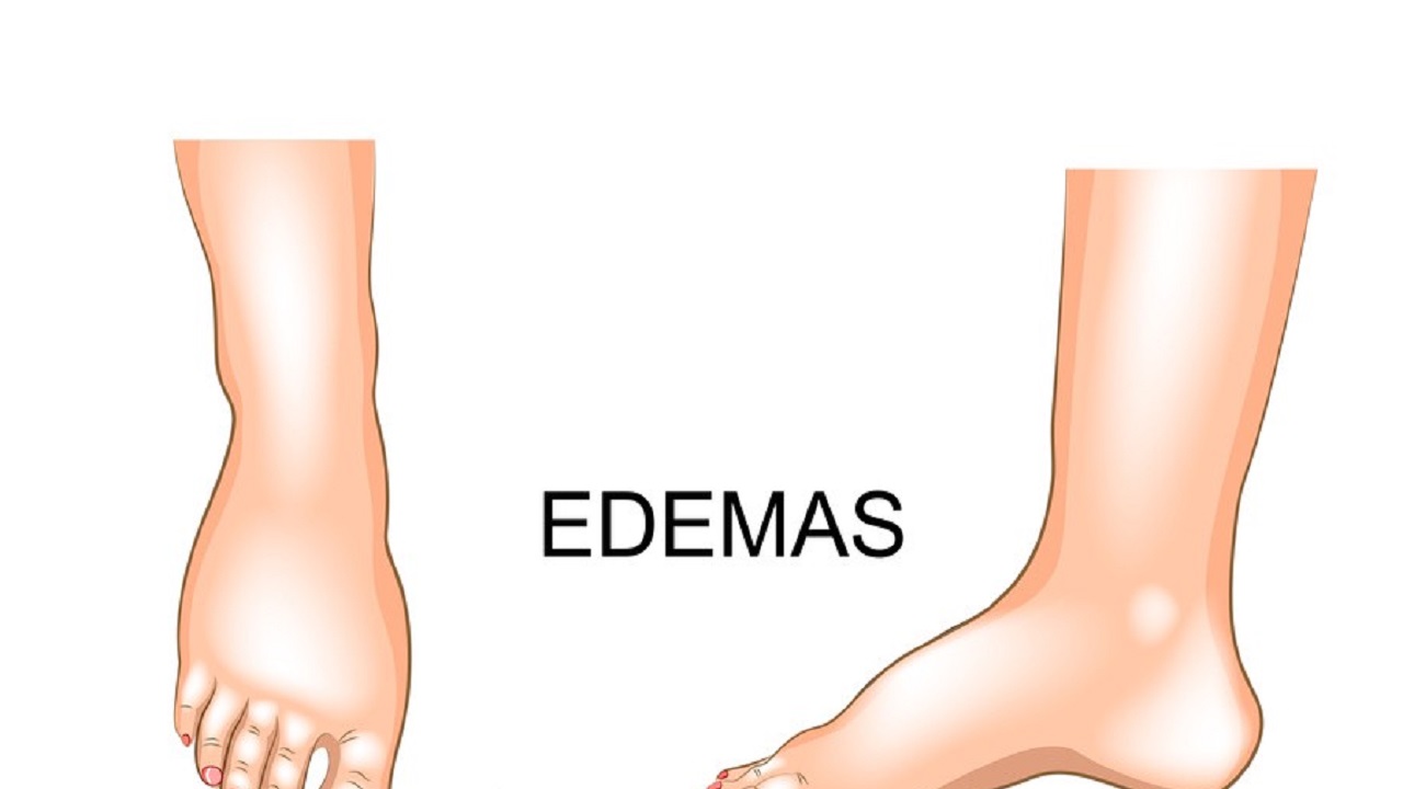 水肿是越来越严重还是突然就水肿,水肿和浮肿的区别是一样的吗