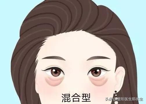 眼袋分型及消除的方法,眼袋分型