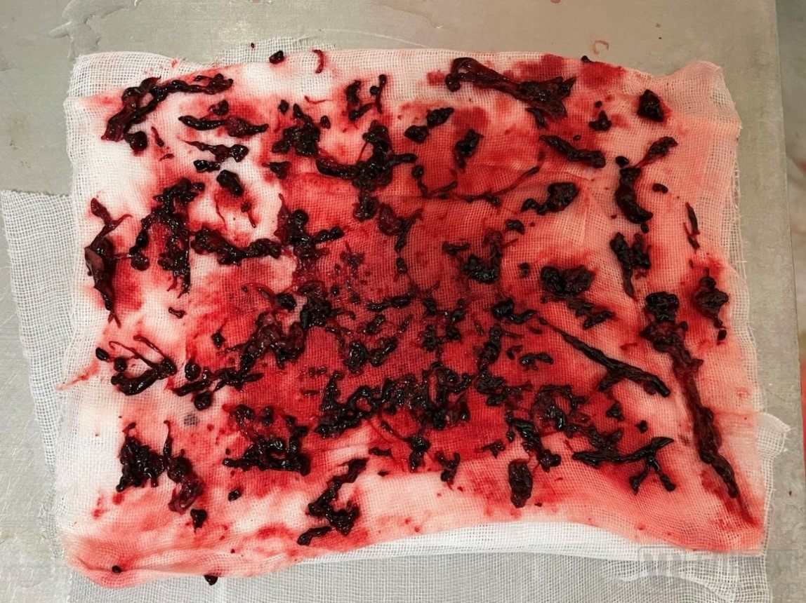 中国医院血栓清除技术,血栓消除的高端技术