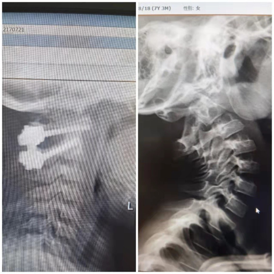 儿童落枕最快恢复办法,落枕了30秒自愈方法儿童