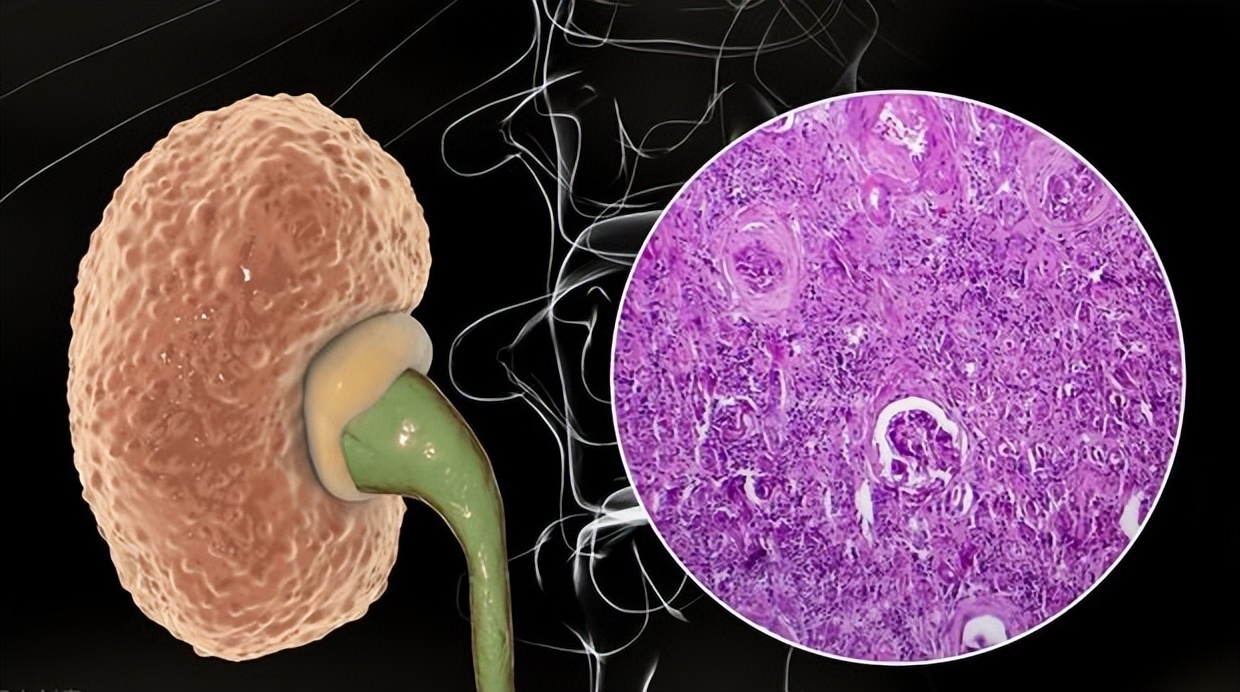 慢性肾病综合征到尿毒症的转化过程及治疗方法