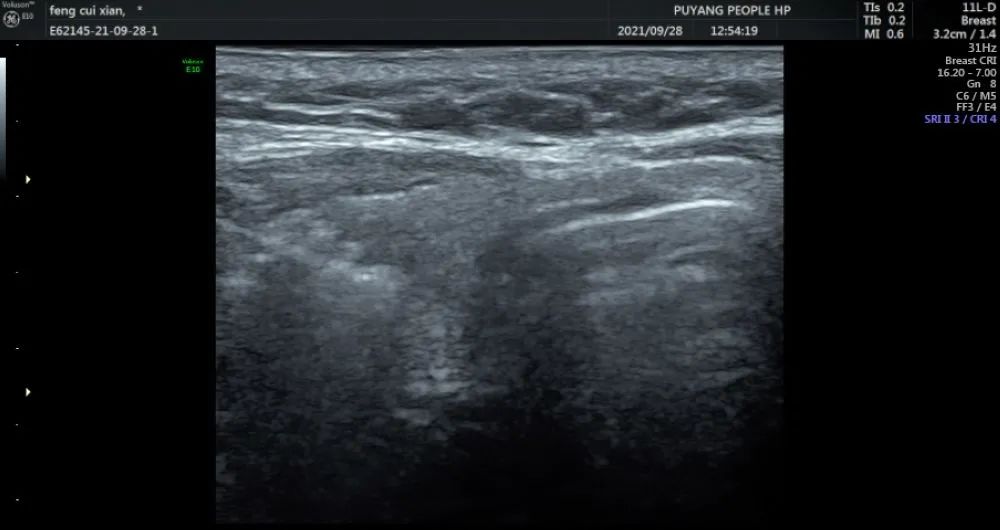 案例分享：3分钟“治愈”甲状腺乳头状癌