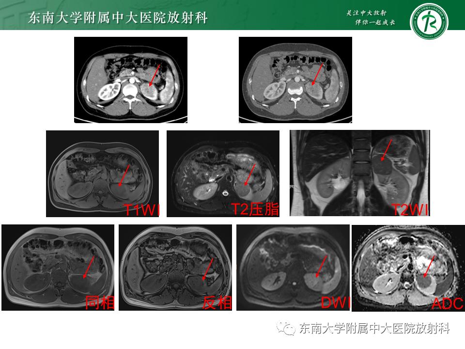 好文分享——《肾血管平滑肌脂肪瘤》