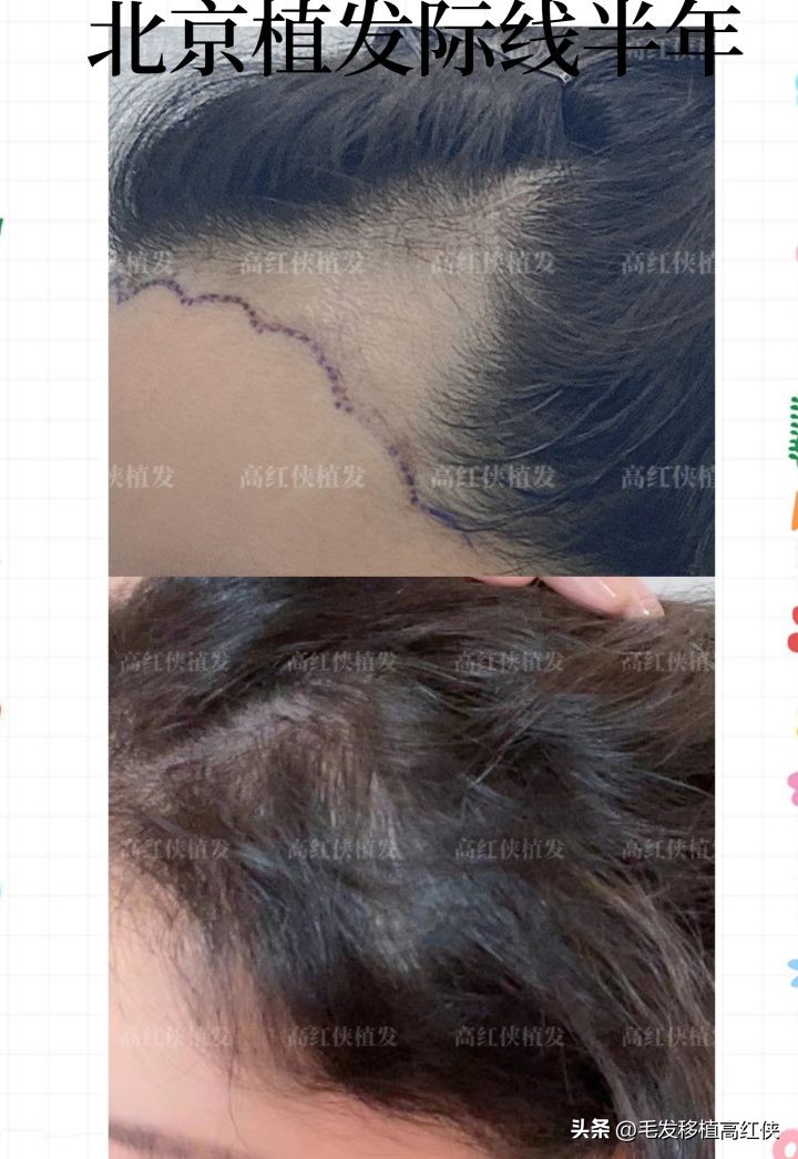 北京植发效果,植发半年后植发区感觉很紧绷