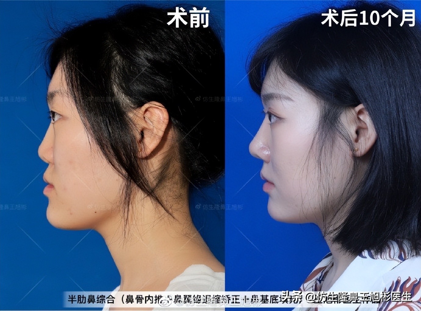 鼻基底填充会移位到鼻孔吗,鼻基底填充假体会拉长人中吗