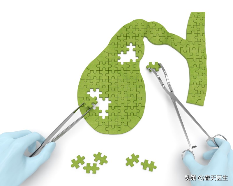 引起胆结石剧痛的石头有多大,胆结石疼痛之后没石头了怎么回事