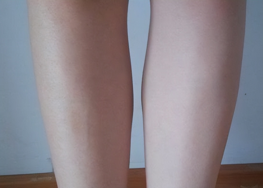 双腿不一样粗细怎么矫正,双腿粗细不一样是怎么回事