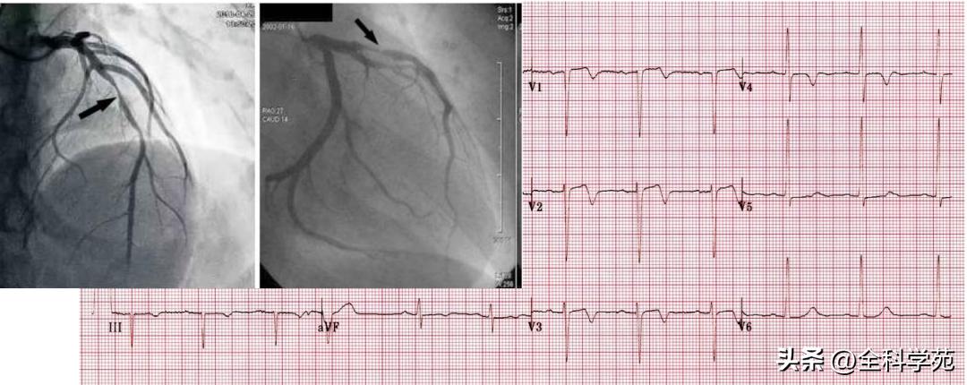 t波倒置三种常见原因,t波低平倒置有事吗