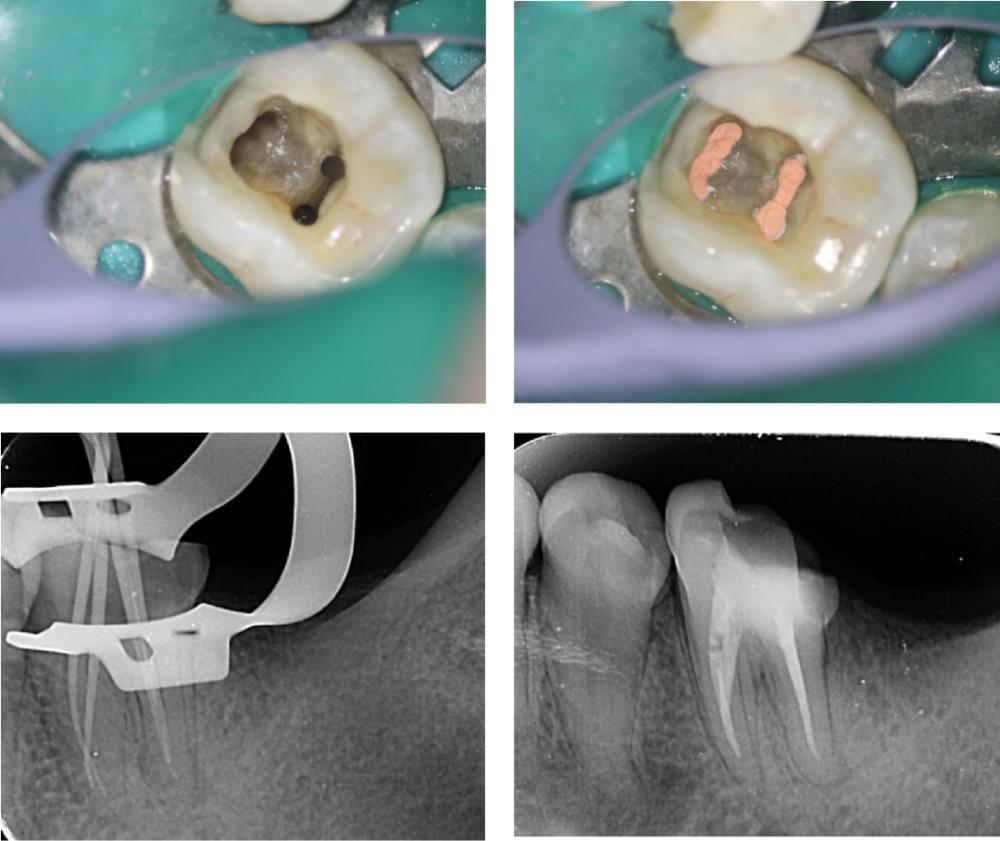 烂牙做根管治疗,烂牙做牙套好吗