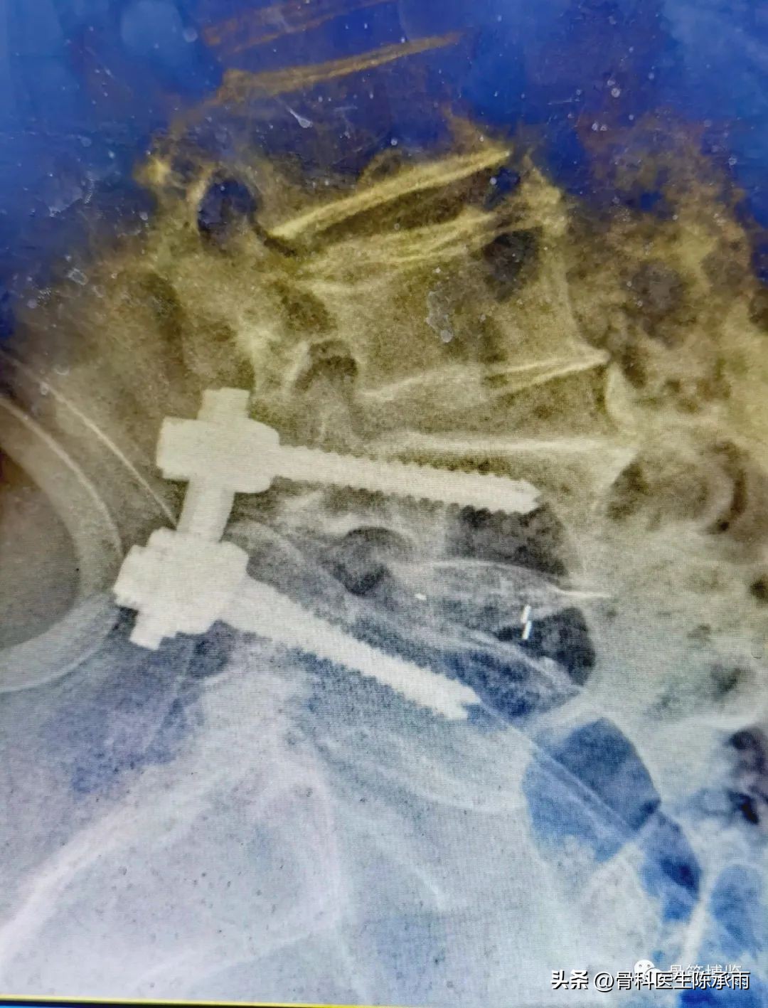 腰椎滑脱椎管狭窄手术后遗症,腰椎间盘突出椎管狭窄的手术