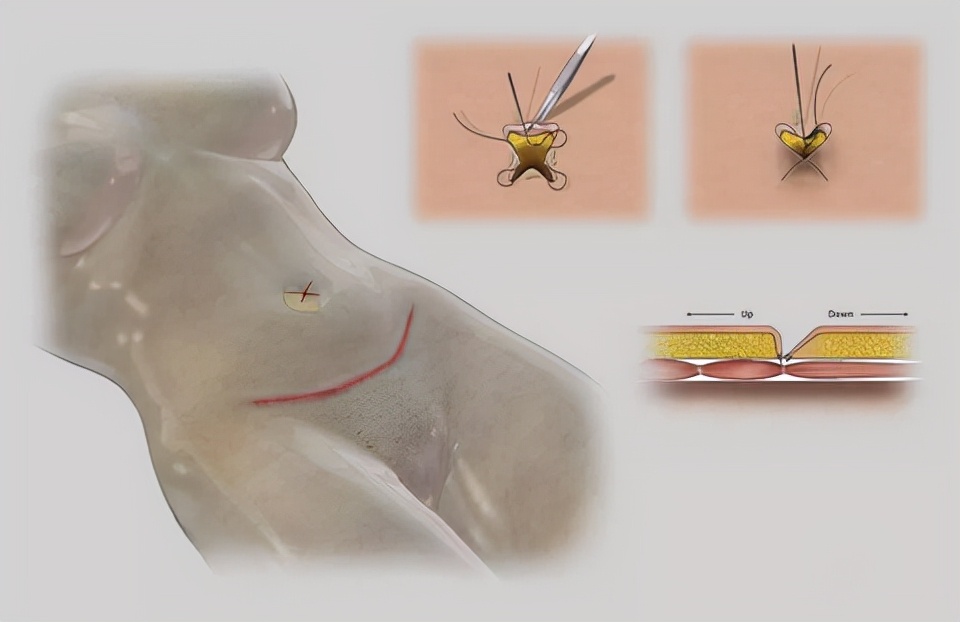 余文林：产后变胖腹壁松弛下垂怎么办？