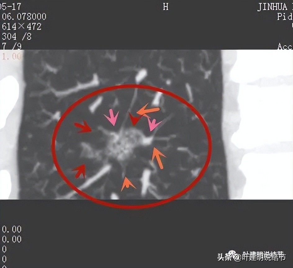 肺蜂窝状改变是肺癌吗,肺部陈旧灶与肿瘤怎么确诊