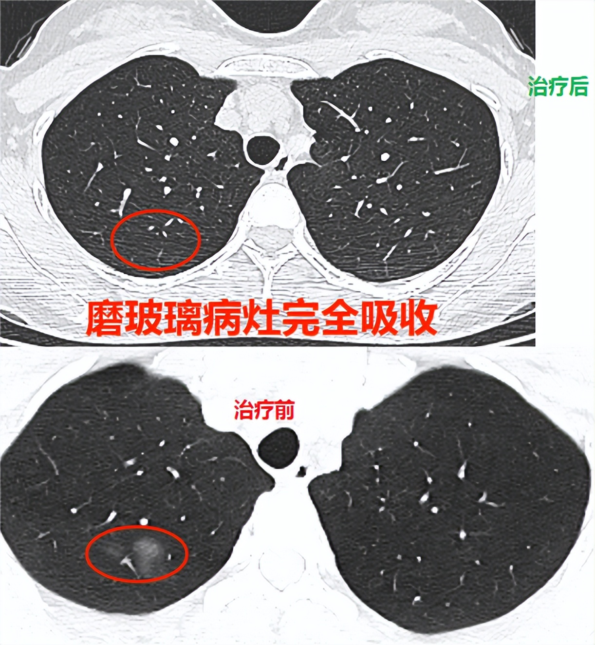 肺部结节不要慌不一定是癌,肺结节应该拍个什么片子