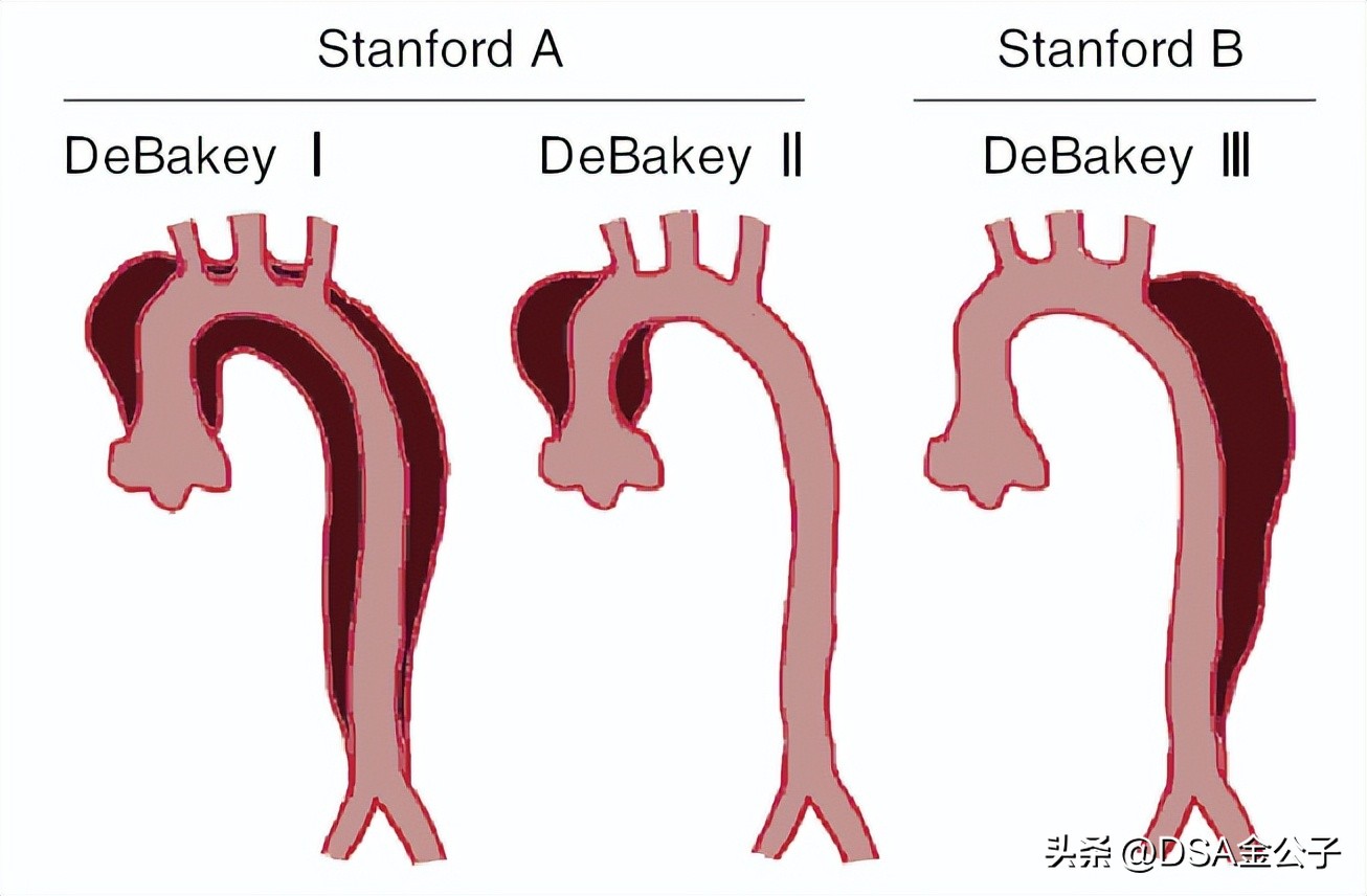 主动脉夹层动脉瘤哪个医院好,主动脉夹层动脉瘤遗传率多高