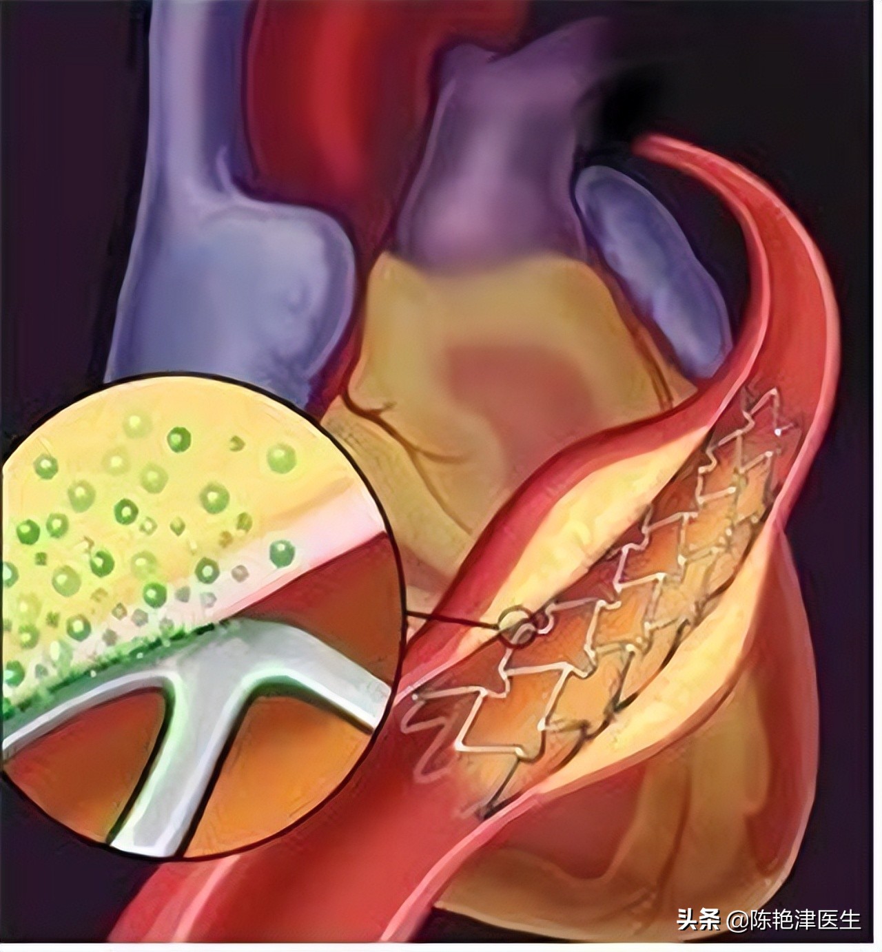 做完冠脉造影身体会虚弱吗,做完冠脉造影容易得癌症吗