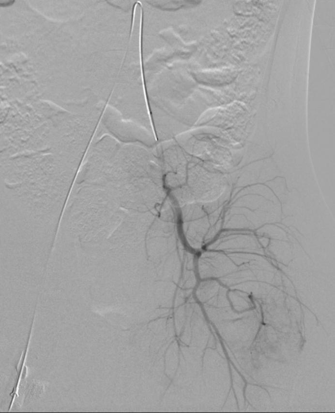 下肢肌间静脉畸形治疗案例,臀部静脉畸形怎么治疗比较好
