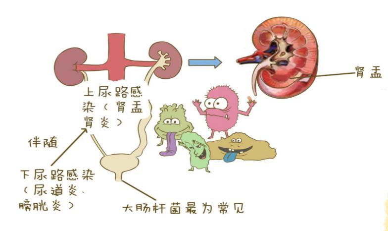 急性肾盂肾炎腰痛反复发作怎么办,急性肾盂肾炎腰痛一般多长时间