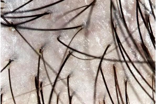 头发细软油头脱发怎么治疗,脂溢性脱发去生发养发馆有用吗