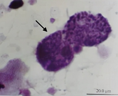 uu感染会自愈么,uu感染是hiv吗