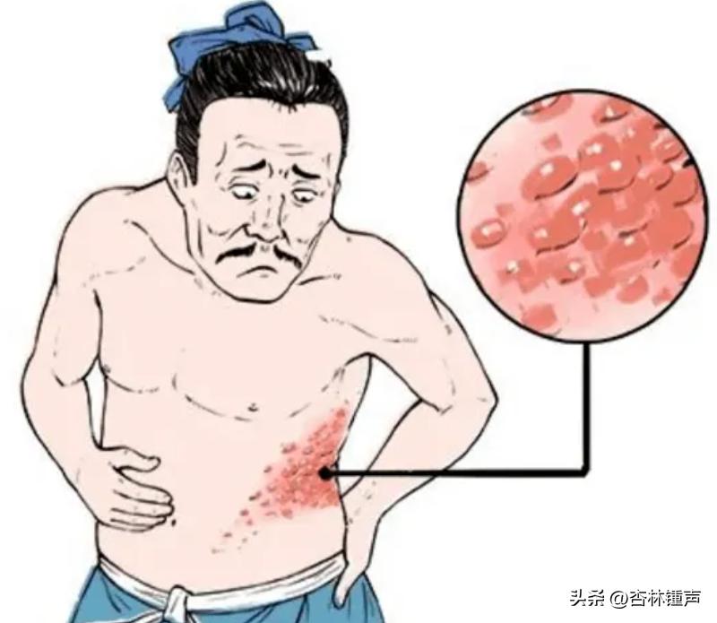 带状疱疹是什么样的怎么治,带状疱疹长在眼睛附近要特别注意